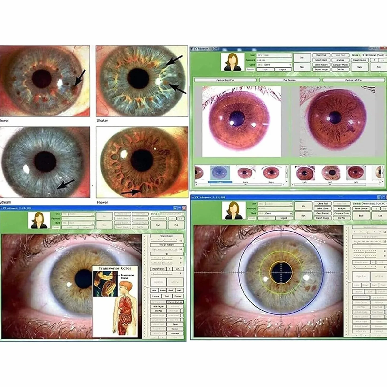 Telecamera per Iridologia, Telecamera per L'Analisi Dell'Iride con Lente Dell'Iride da 1,3 Milioni di Pixel, Rilevatore Dell'Iride, con Software Professionale, con Messa A Fuoco Regolabile